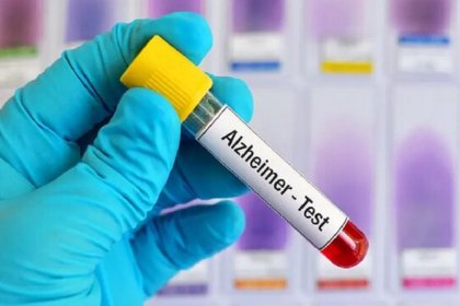 تشخیص آلزایمر با آزمایش خون ممکن شد